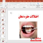 پاورپوینت اختلالات حفره دهان